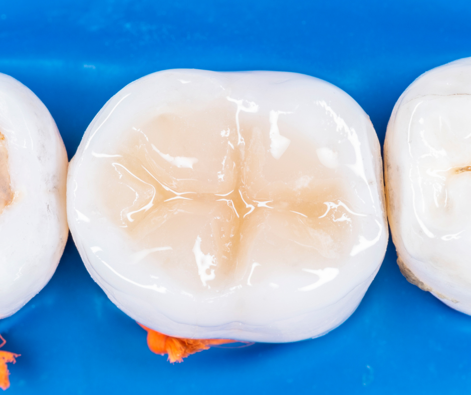 Composite Fillings (Tooth-Colored Fillings) for Children